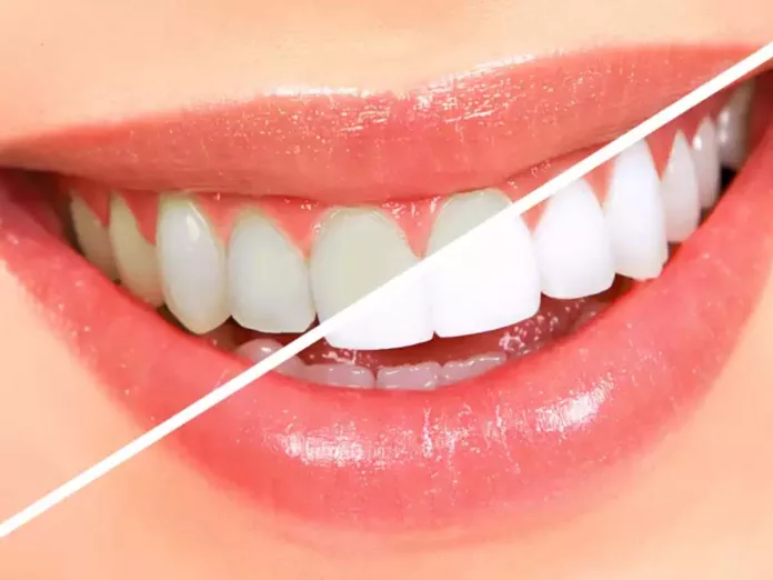 Different Ways to Whiten your Teeth at Home