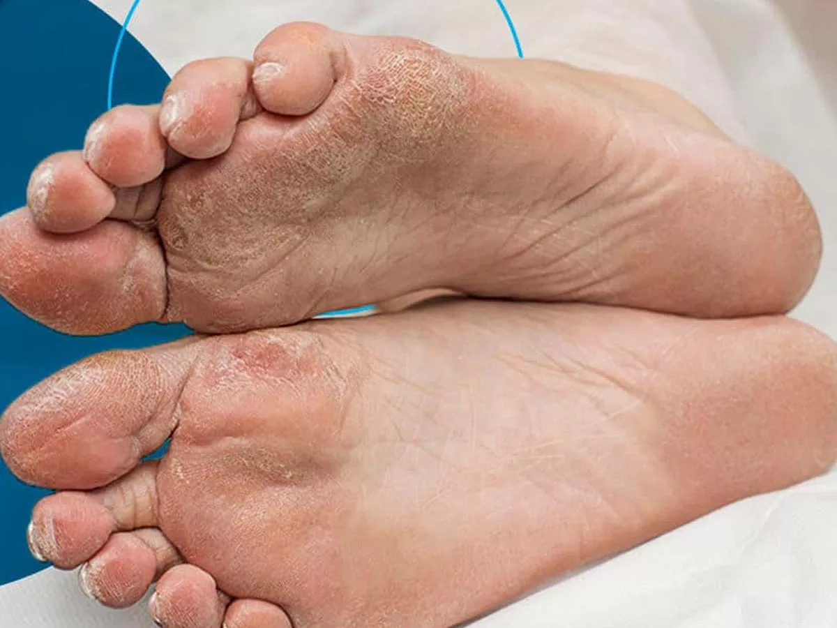 Diabetic Foot : Diabetic patients should pay attention to these things in summer