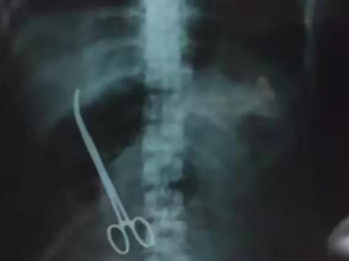 Eluru government hospital doctors leave scissors inside patient stomach