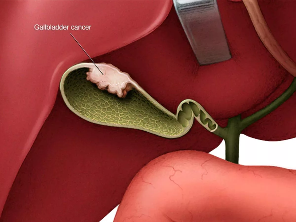 What is Gallbladder Cancer? Its symptoms